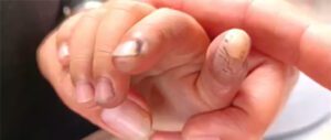 Ngón tay bị bỏng của bé trai sau tai nạn